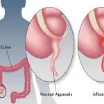 Cosa è l’appendicite?