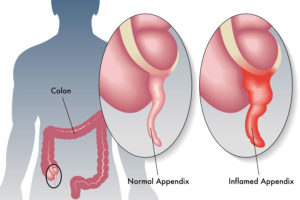 Cosa è l’appendicite?